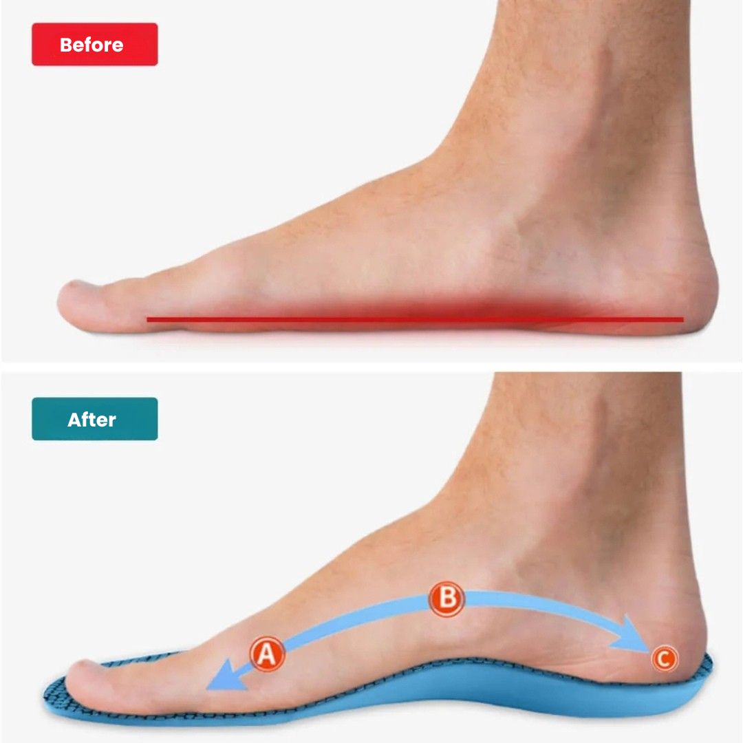 Orthopedic Insoles for Bunions