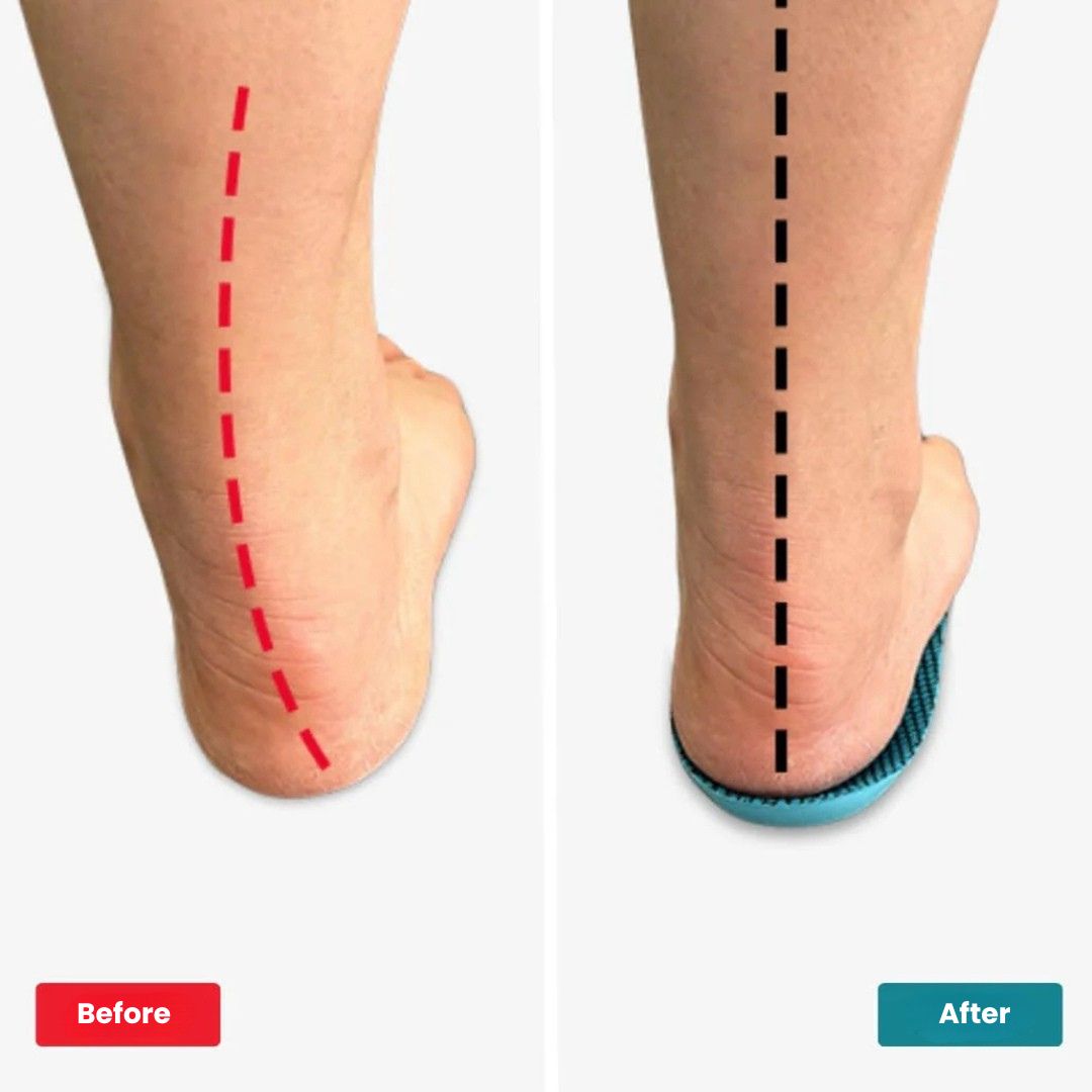 Orthopedic Insoles for Bunions