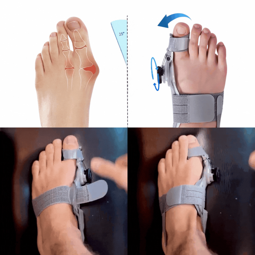 Bunion Fix - Bunion Corrector