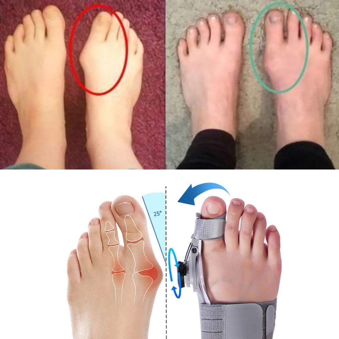 Bunion Fix - Bunion Corrector
