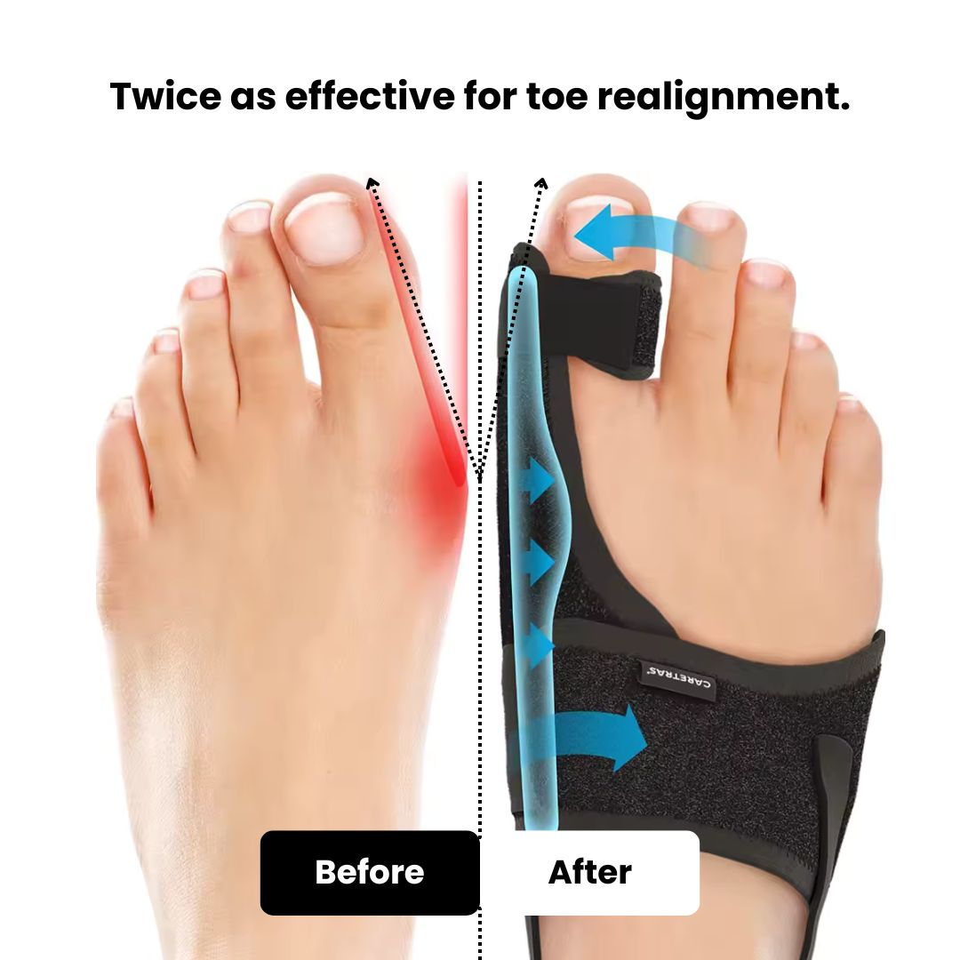 Night Splint for Hallux Valgus (One size fit all)