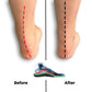 Orthopedic Insoles for Plantar Pain