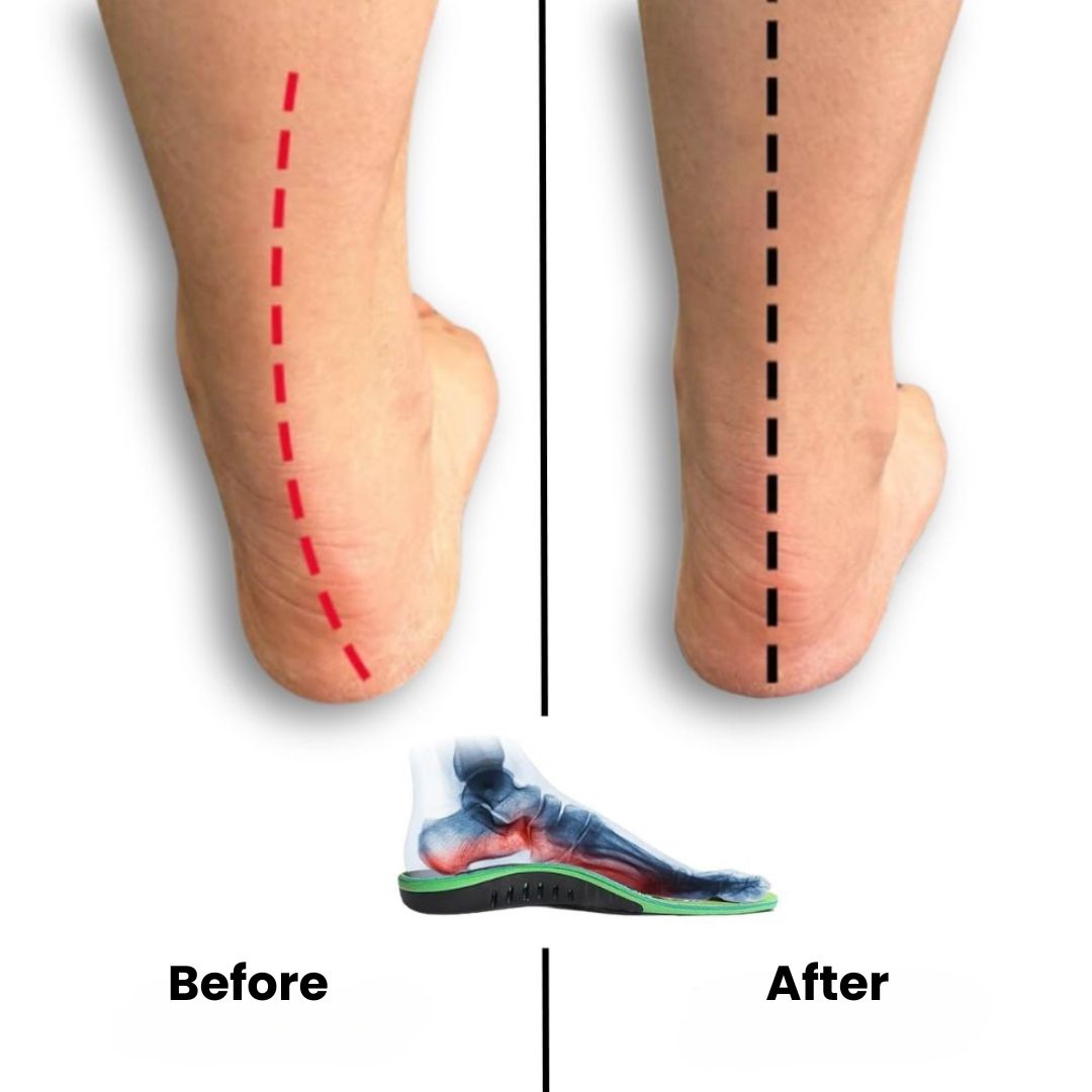 Orthopedic Insoles for Plantar Pain